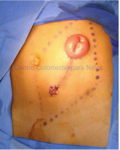 Aspecto postoperatorio de una colostomía en un paciente con malformación anorrectal
