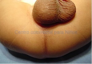Malformación anorrectal sin fístula clínicamente evidente