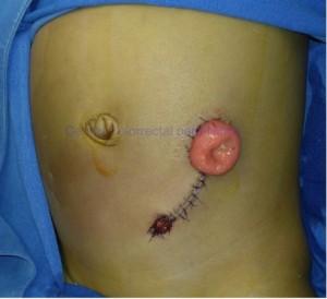 Colostomía en un recién nacido