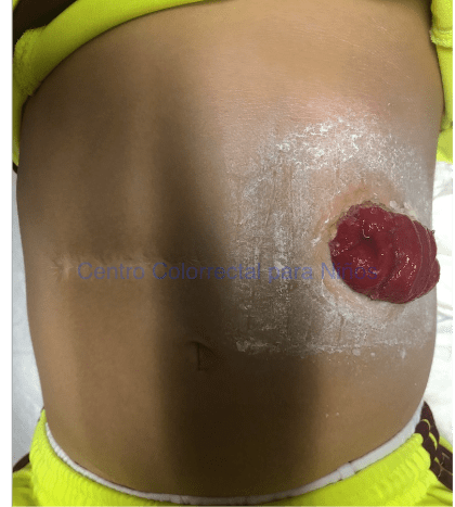 Fotografía de colostomía en asa