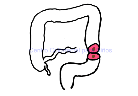 Tipos de colostomías: colostomía en cañón de escopeta
