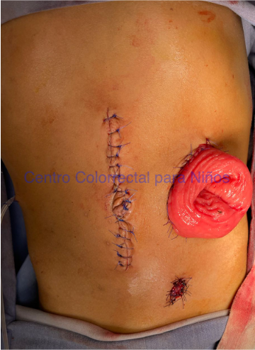 Colostomía en zona normogangliónica en paciente con enfermedad de Hirschsprung