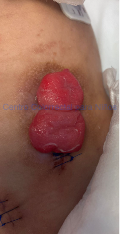 Fotografía de colostomía en cañón de escopeta