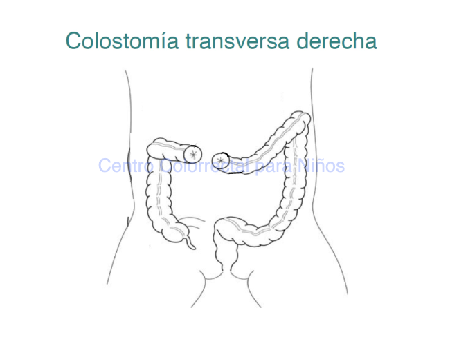 ¿Qué es una colostomía transversa derecha?