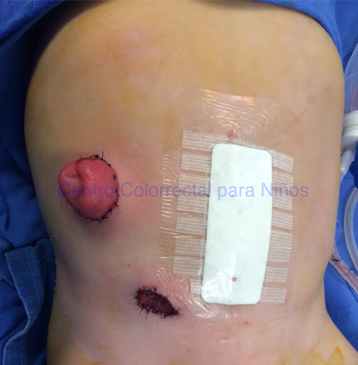 Ileostomía en paciente con enfermedad de Hirschsprung