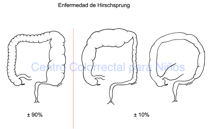 Frecuencia de extensión de la aganglionosis en la enfermedad de Hirschsprung