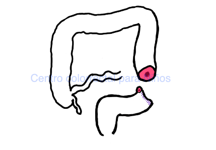 Tipos de colostomías: colostomía proximal con fístula mucosa distal