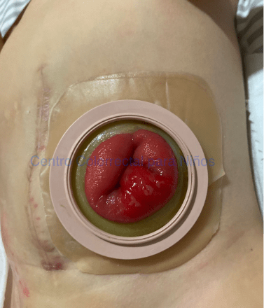 Fotografía de colostomía cerrada en Hartmann