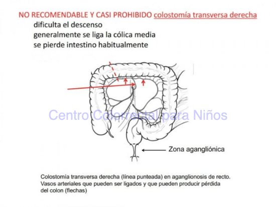 ¿Por qué NO es recomendable hacer una colostomía transversa derecha en un niño con enfermedad de Hirschsprung?