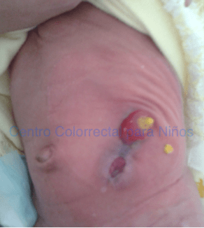 Aspecto final de la colostomía de la fotografía previa: la dehiscencia se resolvió con curaciones y sin cirugía Aspecto final de la colostomía de la fotografía previa: la dehiscencia se resolvió con curaciones y sin cirugía