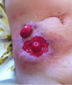 Dermatitis moderada por una colostomía muy cerca de una prominencia ósea (cresta iliaca) Dermatitis moderada por una colostomía muy cerca de una prominencia ósea (cresta iliaca)
