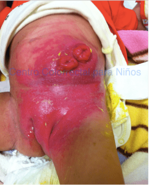 Dermatitis severa en una niña con ambos estomas maduros Dermatitis severa en una niña con ambos estomas maduros