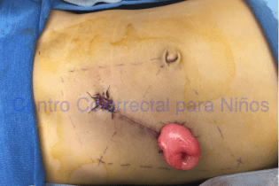 Aspecto postoperatorio de una colostomía en una niña con malformación anorrectal Aspecto postoperatorio de una colostomía en una niña con malformación anorrectal