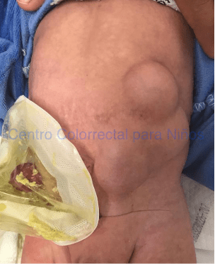 Hernia incisional en el extremo izquierdo de una herida de laparotomía transversa Hernia incisional en el extremo izquierdo de una herida de laparotomía transversa