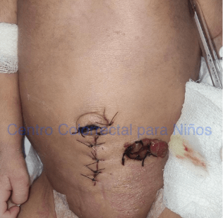 Hernia paraestomal con exteriorización del epiplón en el lateral izquierdo de la colostomía Hernia paraestomal con exteriorización del epiplón en el lateral izquierdo de la colostomía
