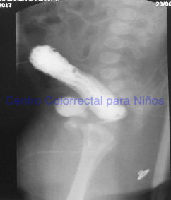 Colograma distal que muestra una colostomía realizada muy distal Colograma distal que muestra una colostomía realizada muy distal