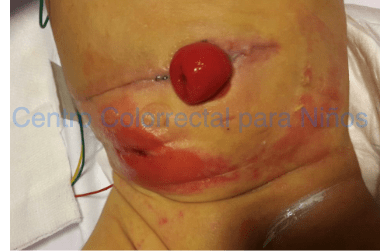 Colostomía de estomas invertidos Colostomía de estomas invertidos