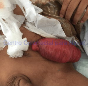 Prolapso de una colostomía (estoma distal)