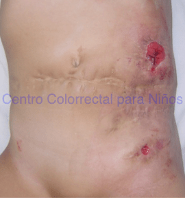 Fotografía de colostomía izquierda de estomas muy separados, uno superior y otro inferior Fotografía de colostomía izquierda de estomas muy separados, uno superior y otro inferior