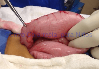 Zona de transición en un paciente con enfermedad de Hirschsprung Zona de transición en un paciente con enfermedad de Hirschsprung