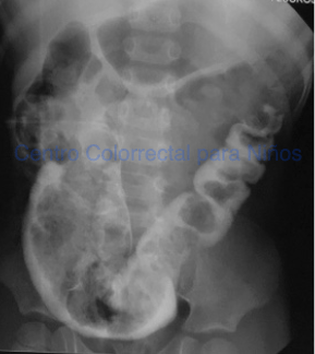 Colograma proximal realizado a través de una colostomía agangliónica Colograma proximal realizado a través de una colostomía agangliónica
