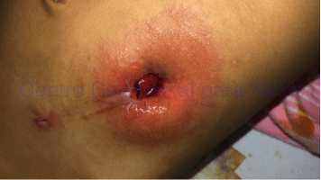 Retracción de la colostomía de la misma paciente a los 6 meses de la cirugía Retracción de la colostomía de la misma paciente a los 6 meses de la cirugía
