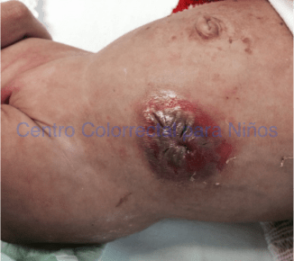Dermatitis grave por un estoma muy plano (de hecho, no se ve donde está) Dermatitis grave por un estoma muy plano (de hecho, no se ve donde está)