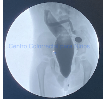 Colograma distal del paciente previo Colograma distal del paciente previo