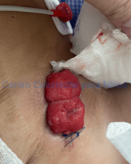 Estenosis de una colostomía invertida Estenosis de una colostomía invertida