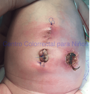 Necrosis de una colostomía Necrosis de una colostomía