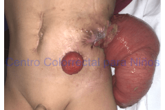 Prolapso de una colostomía