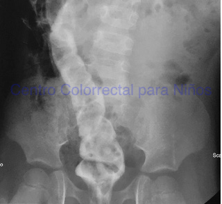 Colograma distal en una paciente que parecía tener una colostomía transversa derecha Colograma distal en una paciente que parecía tener una colostomía transversa derecha