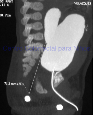 Cloacograma que muestra una colostomía realizada muy distal Cloacograma que muestra una colostomía realizada muy distal