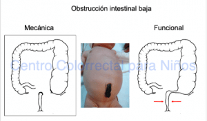 Diferencia entre obstrucción intestinal mecánica y funcional