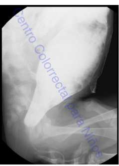 Colon por enema en paciente con enfermedad de Hirschsprung limitada al recto