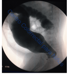 Colon por enema con índice recto sigmoideo menor de 1. El paciente tenía la enfermedad de Hirschsprung Colon por enema con índice recto sigmoideo menor de 1. El paciente tenía la enfermedad de Hirschsprung
