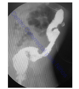 Colon por enema con mucosa espiculada y francos datos de colitis Colon por enema con mucosa espiculada y francos datos de colitis