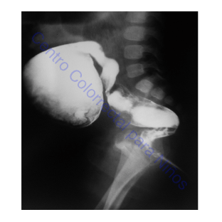 Colon por enema con recto pequeño y sigmoides dilatado Colon por enema con recto pequeño y sigmoides dilatado