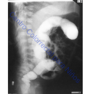 Colon por enema SIN evidencia de una zona de transición Colon por enema SIN evidencia de una zona de transición