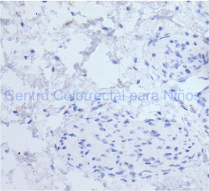 Tinción de inmunohistoquímica calretinina negativa: todo el tejido se observa azul