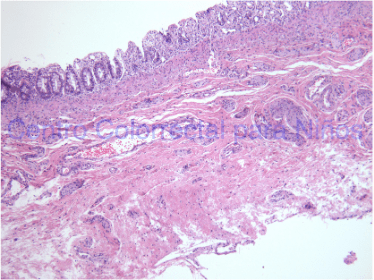 Biopsia de recto adecuada para el diagnóstico