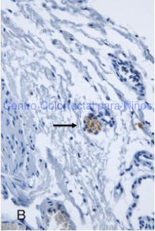 Tinción de inmunohistoquímica calretinina positiva: se observa color café dentro de un plexo