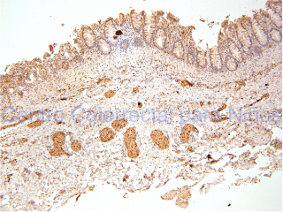 Tinción de inmunohistoquímica PS100 que muestra hipertrofia de troncos