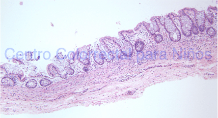 Biopsia de recto insuficiente para el diagnóstico