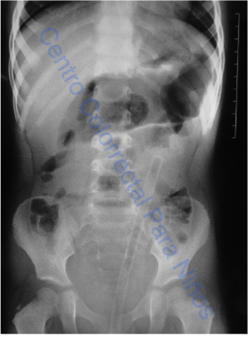 Radiografía de abdomen tras irrigación