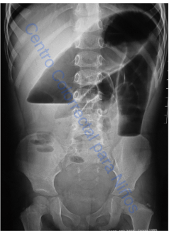 Radiografía de abdomen con dilatación de colon