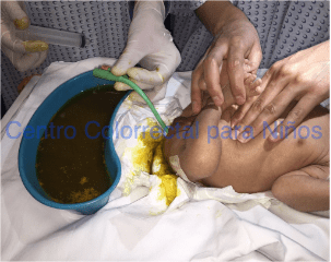 Imagen durante un procedimiento de irrigaciones Imagen durante un procedimiento de irrigaciones