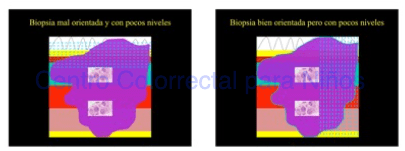Biopsia con pocos niveles o inadecuadamente orientada
