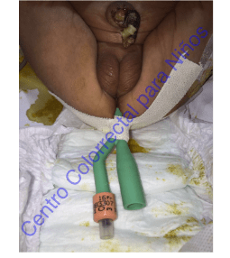 Colocación y fijación de sonda transrectal Colocación y fijación de sonda transrectal