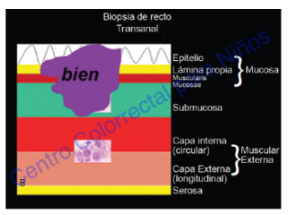 Biopsia de recto bien tomada: espesor suficiente para dar un diagnóstico